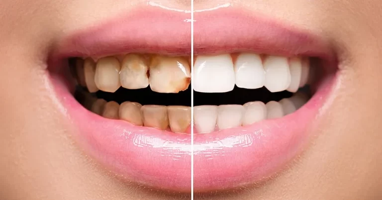 Common problems that veneers can treat