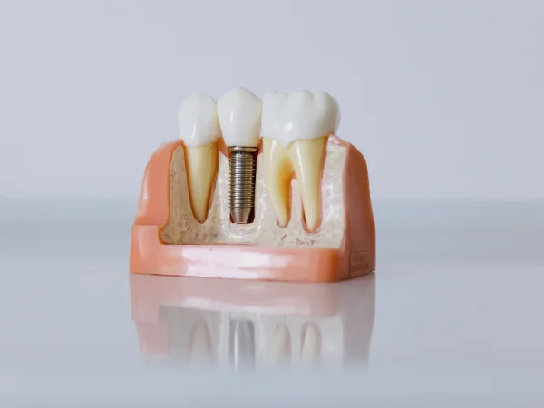 dental implant