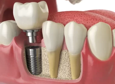 dental-implants-1-920x690.jpg